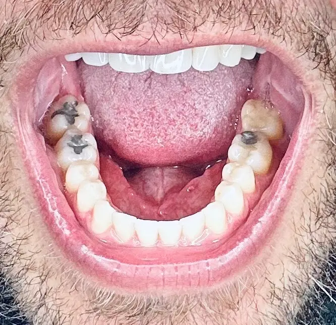 Bigoleteeth14